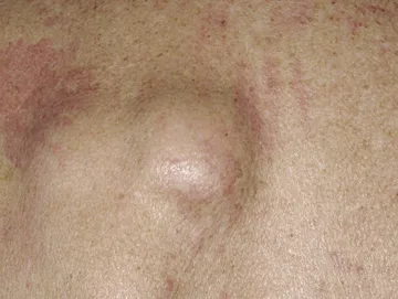 Skin with a raised, discolored patch.