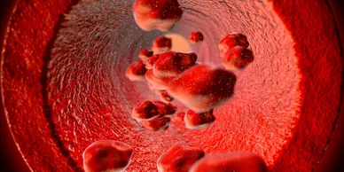 Cholesterol buildup inside a blood vessel.