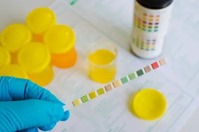 Urine test strip held by gloved hand.