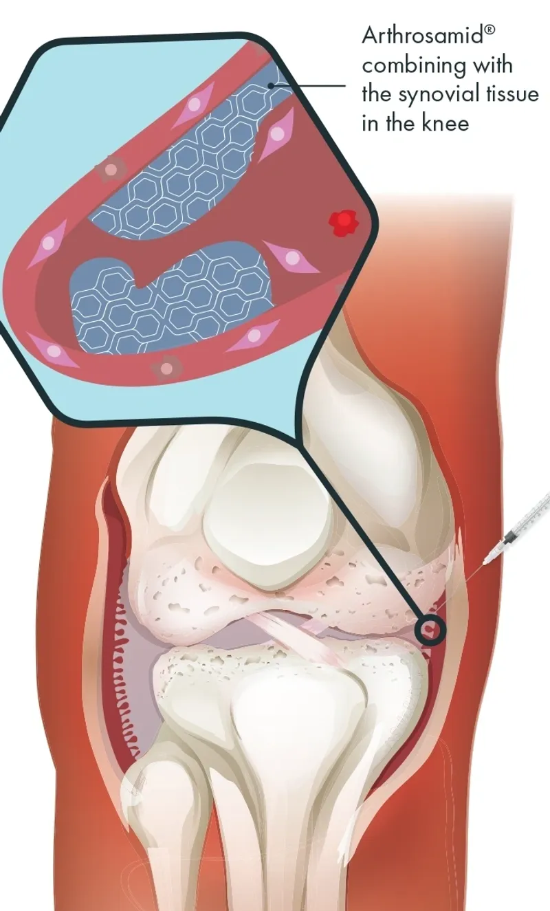 Knee joint with Arthrosamid injection illustration.