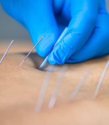 Gloved hand inserting acupuncture needles into skin.