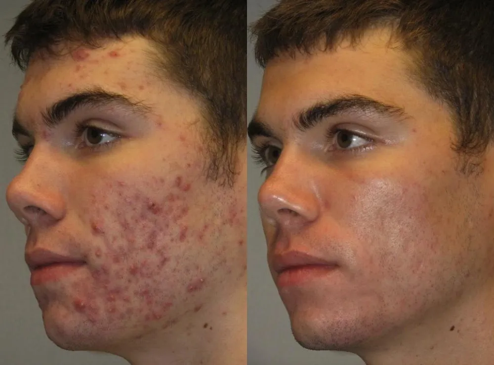 Before and after acne treatment comparison.