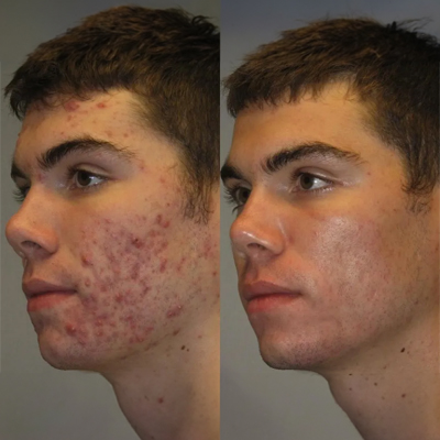 Acne Treatment